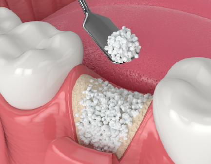 Bone Augmentation